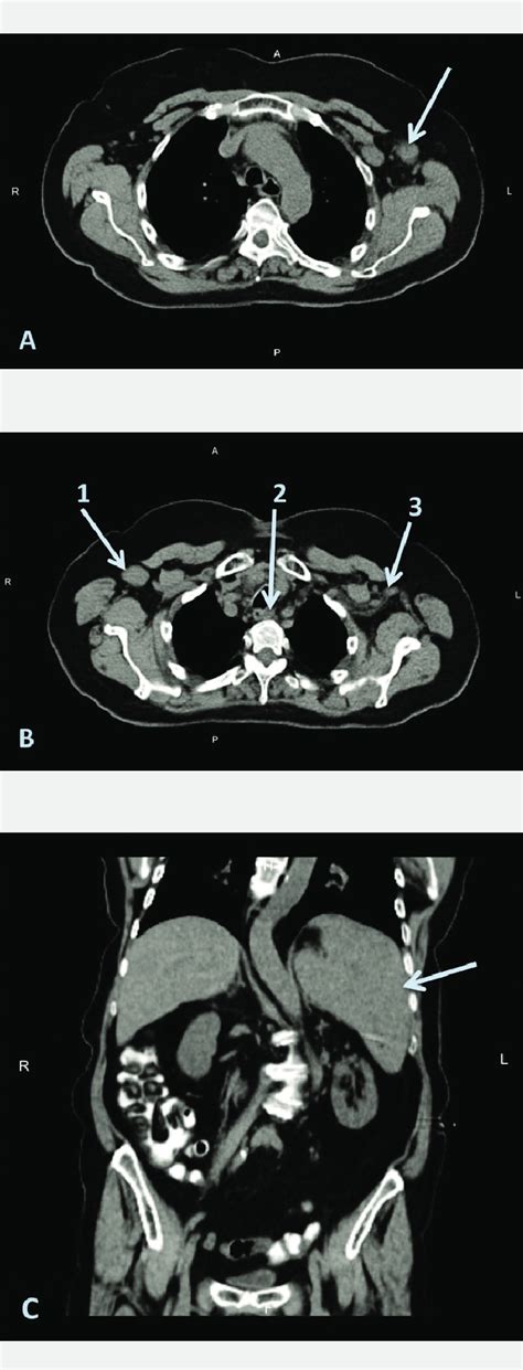 Pet Ct Images Showing Diffuse Lymphadenopathy In Axillary Regions