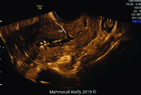 2d Shg Image Of A Sagittal Section Of The Uterus Showing The Rmt