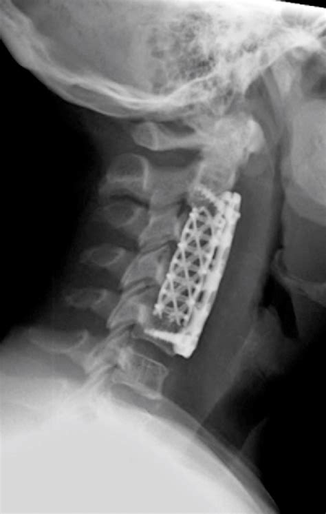 Safety And Efficacy Of Multilevel Acdfaccf Surgery Anterior Cervical