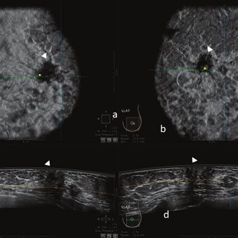 50 Year Old Patient With Biopsy Proven Left Breast Carcinoma A 3d