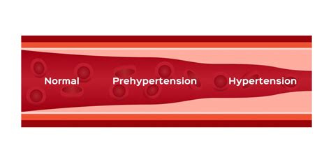 The Benefits Of Cbd For Those With High Blood Pressure Cannabidiol 360