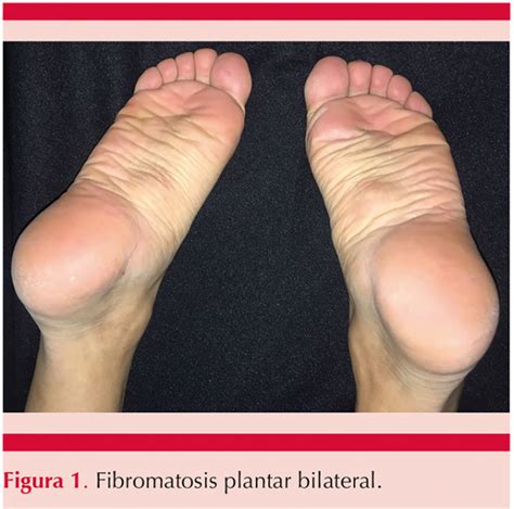 Fibromatosis Plantar Bilateral Diagnóstico Clínico Y De Imagen
