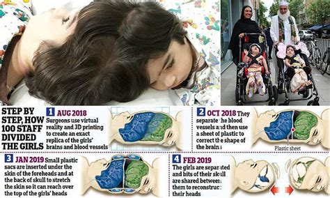 Two Year Old Sisters Safa And Marwa Ullah Had Three Major Operations To Separate Their Heads At