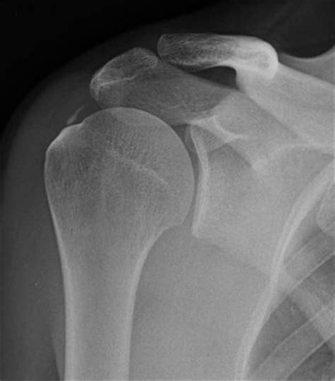 Calcific Tendinitis Radiology Reference Article Radiopaedia Org