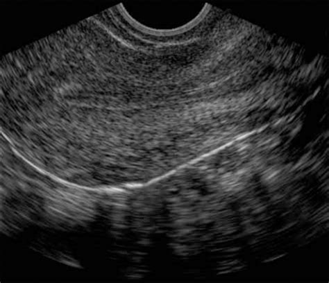 aium practice guideline for the performance of pelvic ultrasound examinations 2010 journal