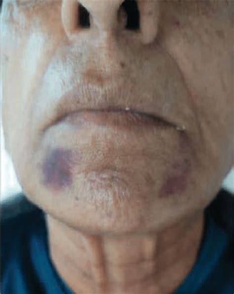 Bruising After Perioral Rejuvenation With Ha Fillers Using A Cannula