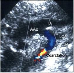 aortic coarctation echocardiography wikidoc