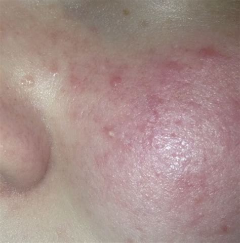Fleshy Coloured Bumps On Face General Acne Discussion Forum