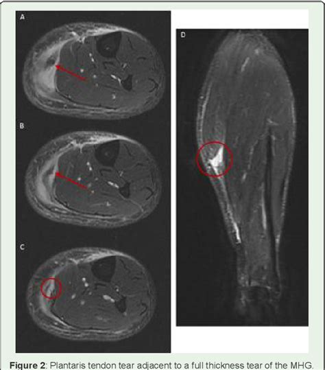 Pdf Mri Evaluation Of Calf Hematoma Frequency Of Plantaris Tendon