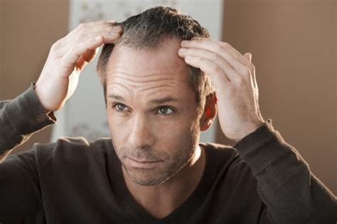 Best Hair Loss Treatments For Men What Are The Options Queen Of Reviews