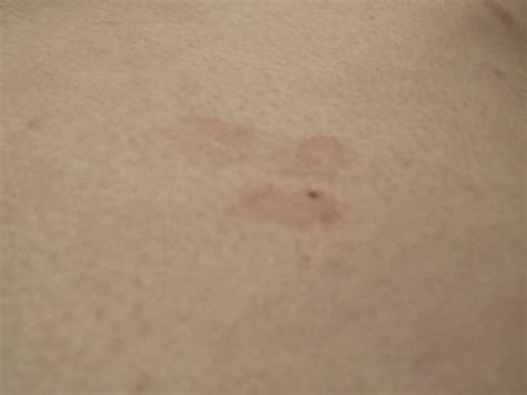 Anyone Know What These Red Spots On My Torso Could Be I Have More Than