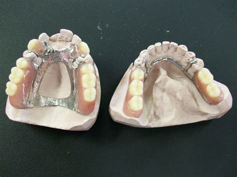 Cast Partial Dentures Procare Dental