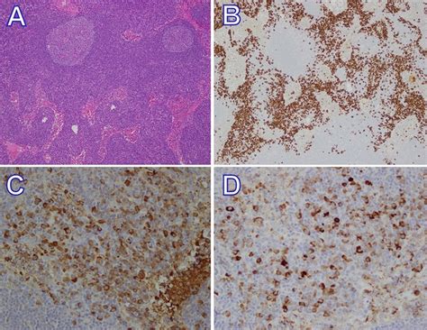 Excisional Lymph Node Biopsy Shows Reactive Lymphoid Hyperplasia A