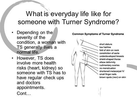 Pin By Nonas Arc On Turner Syndrome Turner Syndrome Turner Syndrome