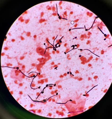 Yeast Having A Party In A Patients Sputum Gram Stain Rmicrobiology