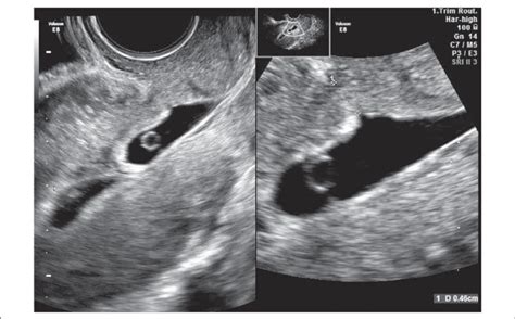 6 Week Transvaginal Ultrasound