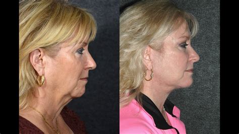 Natural Facelift Before And After By One Of Best Plastic Surgeon Nyc Dr