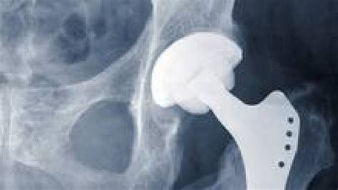 Fda Panelists Discourage Use Of Metal Hip Implants Cbc News