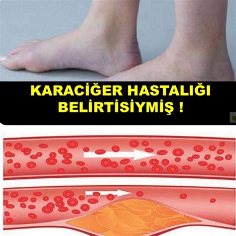 Karaci Er Kanseri Nedir Belirti Ve Tedavi Y Ntemleri Nelerdir Hot Sex