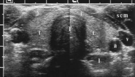Thyroid Gland Ultrasound Anatomy