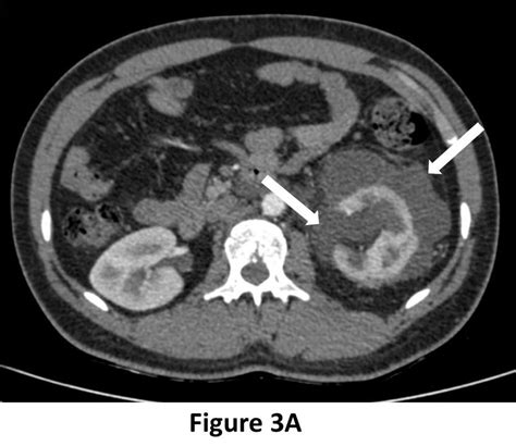 A Ct Scan Of Abdomen And Pelvis In Nephrographic Phase Axial Section