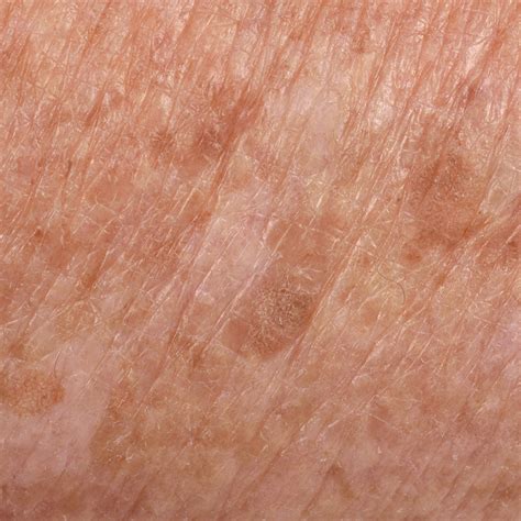 Brown Age Spots On Skin