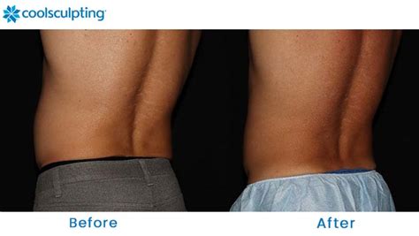 Coolsculpting Before And After Pictures Male Flanks