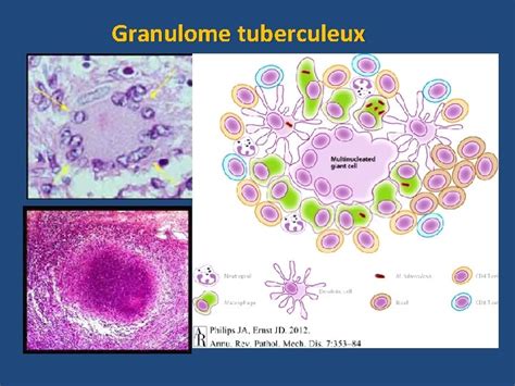 Linfection Tuberculeuse Dr F Khalouf La Tuberculose Maladie