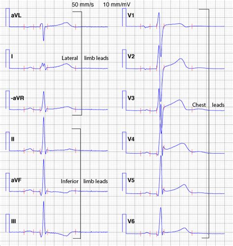The Ecg Leads Electrodes Limb Leads Chest Precordial Leads 12