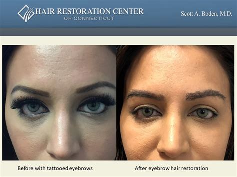 Eyebrow Hair Transplantation Hair Restoration Hartford