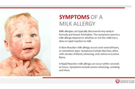 Common types of allergic reactions in infants include the following Milk Allergy