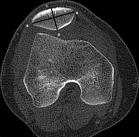 Assessment Of Patellar Morphology In Trochlear Dysplasia On Computed