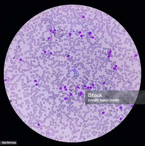 Leukemia Blood Cells Blast Cells And Immature Leukocytic Cells In