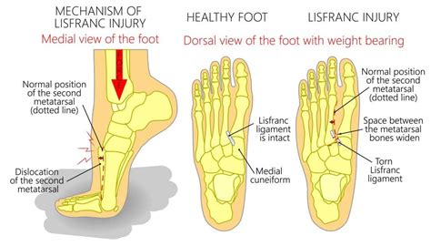 Midfoot Sprain Symptoms And Treatment Explained By A Specialist