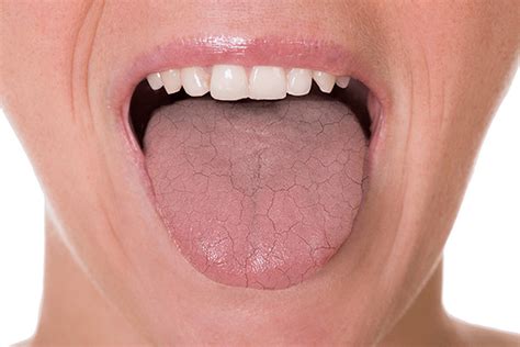 Dry Mouth Causes And Treatment