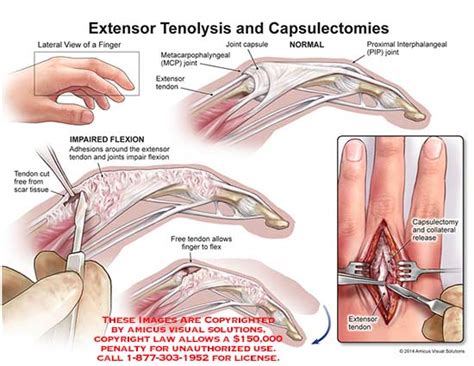 Amicus Illustration Of Amicus Surgery Extensor Tenolysis Capsulectomies Finger