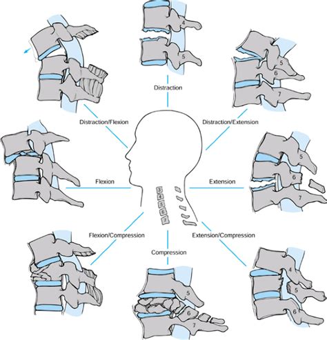 Fractures And Dislocations Of The Cervical Spine From C 3 To C 7