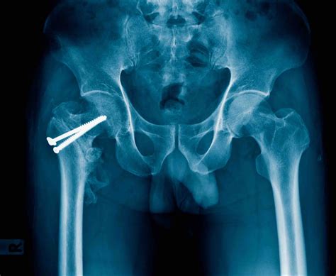 Hip Fracture Treatment With Surgical Screws Arlington Orthopedics Associates Pa Arlington