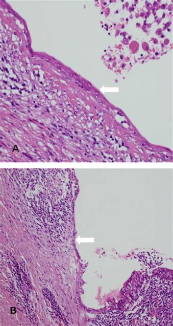 A H E 200 Microscopic Examination Of Epithelial Inclusion Cyst