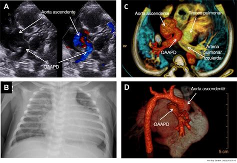 Origen Anómalo De La Arteria Pulmonar Derecha Revista Española De