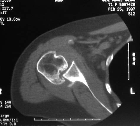 Chronic Glenohumeral Dislocation: Anterior and Posterior
