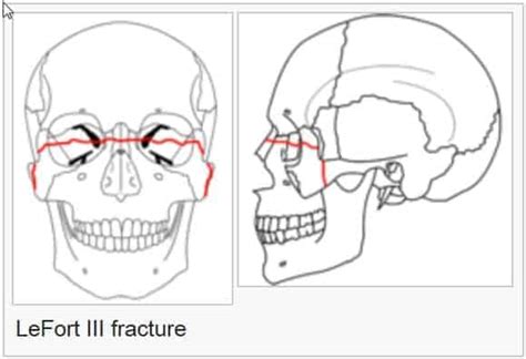 Fracture Of The Facial Bones Nosemaxillamandiblezygomatic
