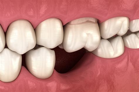 Tooth And Bone Loss In Pensacola Fl Gum Disease Dr David Williams
