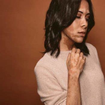 Pigmentstörung) ist immer dann die rede, wenn sich die farbpigmente der haut ungleichmäßig verteilen bzw. Vitiligo - Entstehung und Behandlungsmöglichkeiten ...