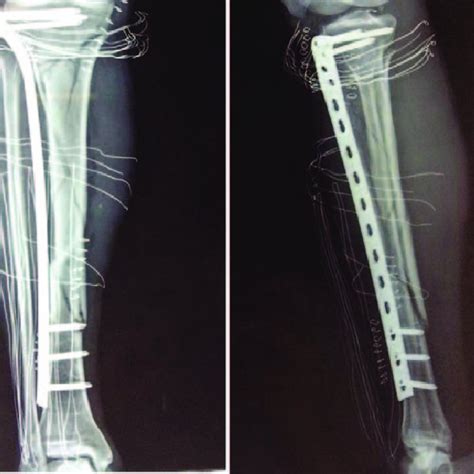 Postoperative Radiograph Of Tibia Fracture Mipo Surgery Showing Good