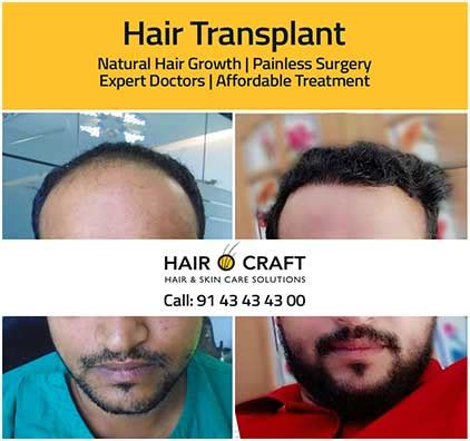 Hair Transplant Hairocraft Global