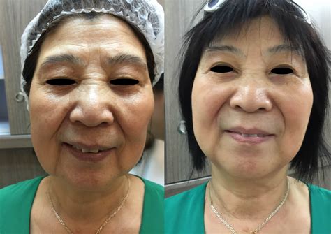 Natural Face Lift Treatment Microneedling For Scars M Day Spa