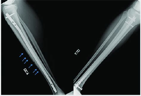 Post Operative Radiographs With Tibial Nail Anterior Cortical