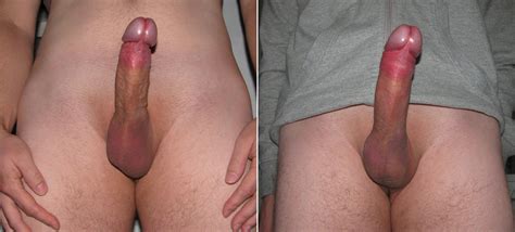 Cock Penis Pump Before And After Hot Nude Comments 1