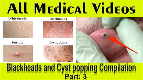 Blackheads And Cyst Popping Compilation Part 34 All Medical Videos